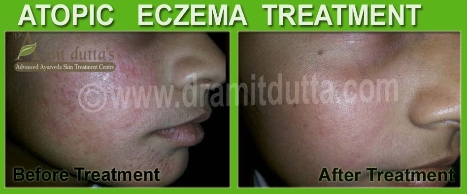 Atopic-Eczema-ayurvedic-skin-treatment