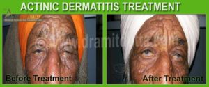 Actinic Dermatitis Ayurvedic Treatment In India. Dramitdutta