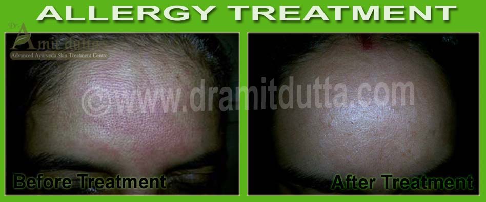 Allergy-ayurvedic-skin-treatment