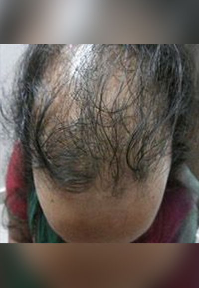 Ayurveda-Female-Hair-Disord
