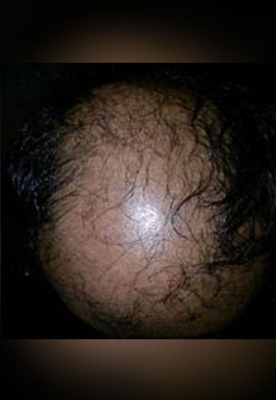 Ayurveda-Male-Hair-Disorder