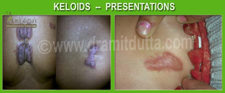 Keloids treatment in Ayurveda in India