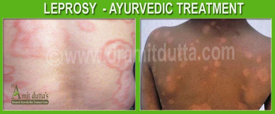 Leprosy-ayurvedic-skin-treatment
