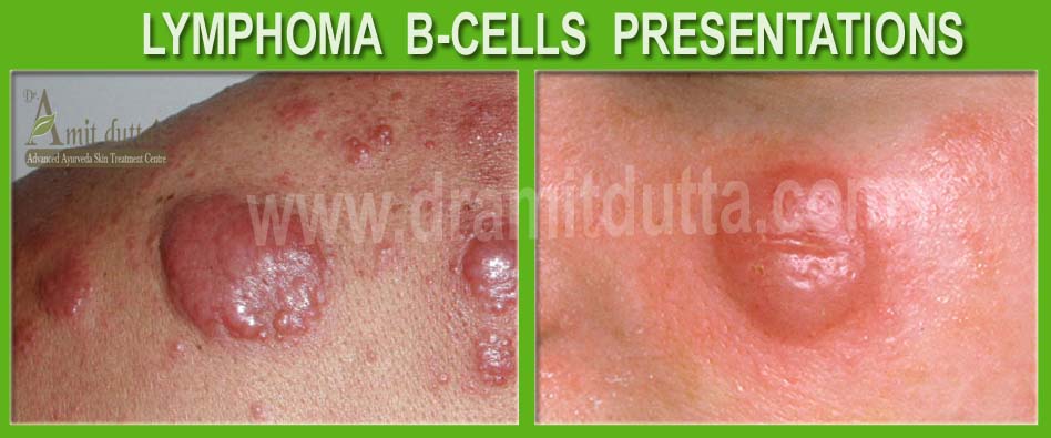 Lymphome-B-Cells-ayurvedic-skin-treatment