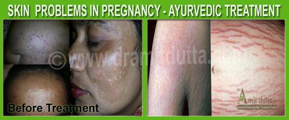 Skin-Problems-in-Pregnancy-ayurvedic-skin-treatment