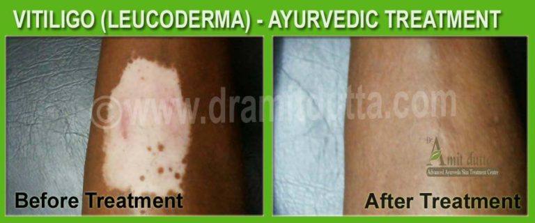 Vitiligo Ayurveda View & Concept - Dr. Amit Dutta's Clinic