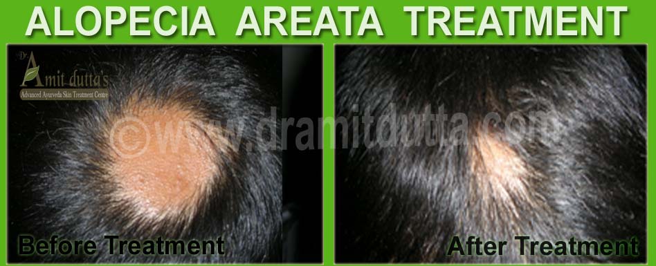 Qoo10  AroMine Jonk Oil Leech Oil for Hair Growth and for Hair Fall  Control  Hair  Body  Na
